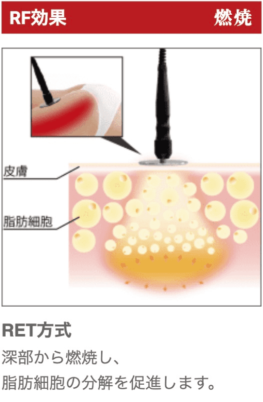 RF効果 燃焼 RET方式 深部から燃焼し、脂肪細胞の分解を促進します。